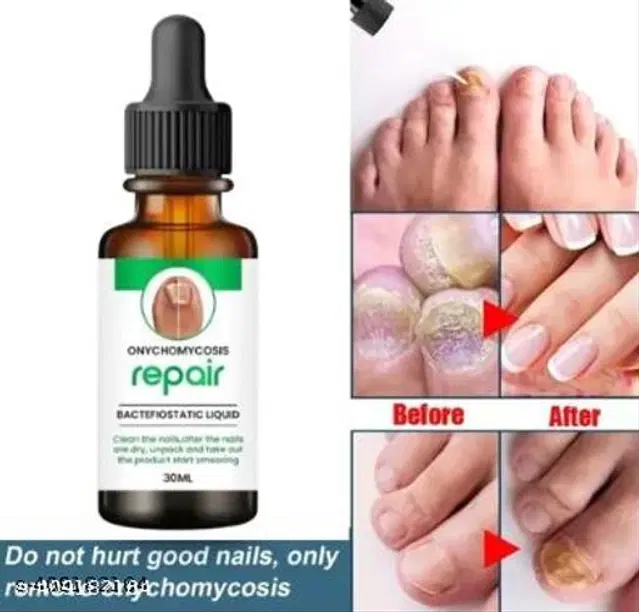 Onychomycosis Nail Serum, 30 ml