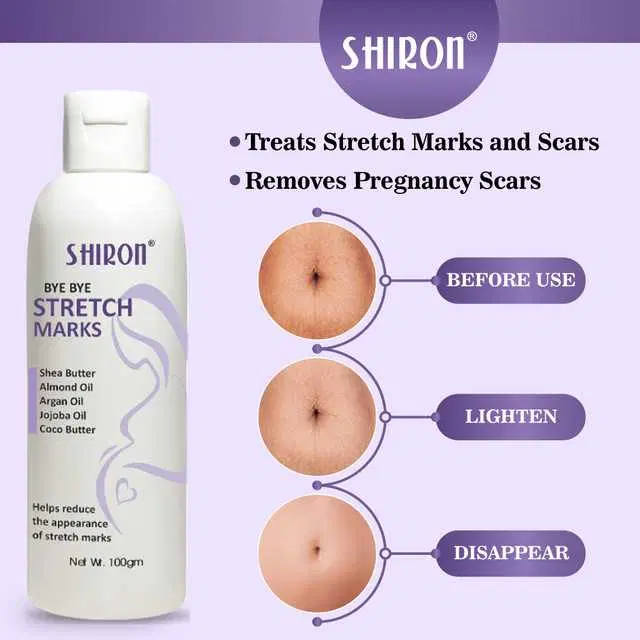 Pregnancy And Young Age Stretch Mark Removable Cream, 100 ml, MT-02