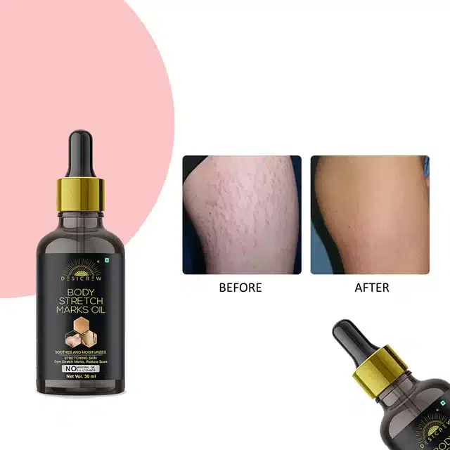 Stretch Mark Removal Oil, 30 ml