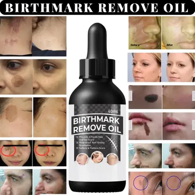 Natural Birth Marks and Blemish Removal Oil, 50 g