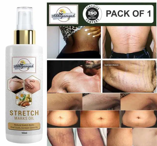 Abhigamyah Present Repair Stretch Marks Removal Natural Heal Pregnancy Breast, Hip, Legs, Mark Oil, 100 ml, Pack Of 1, A-988