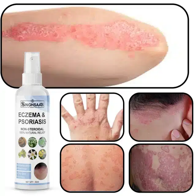 SinghSaab Eczema & Psoriasis Relief Spray, 50 ml