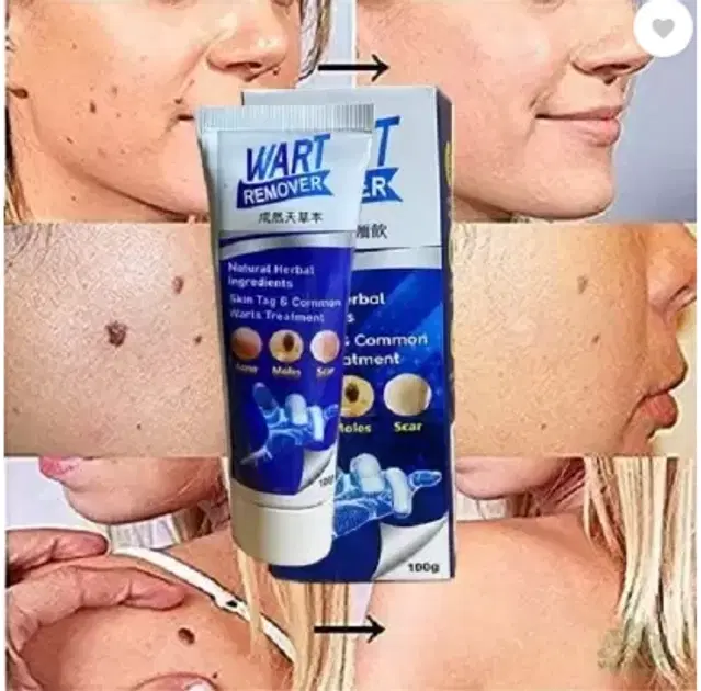 Atemporal Warts Remover Cream, 100 g